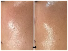 エフェクト 塚口店(effect)/Before After &nbsp;&nbsp;30代/2回目