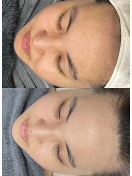 レクシア(LEXIA)/肌質改善症例｜赤みケア