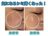 【シミ撃沈♪】エレクトロポレーションで奇跡のシミ集中ケア!!美肌へ☆