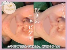 ハーバリー ハーブピーリング 大阪梅田店(HERBERRYハーブピーリング)/梅田ハーブピーリングHERBERRY