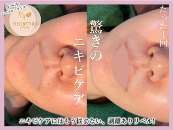 ハーバリー ハーブピーリング 大阪梅田店(HERBERRYハーブピーリング)/梅田ハーブピーリングHERBERRY