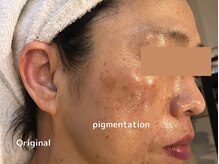 オアシスラグーン(OASIS LAGOON)/シミケア（症例４：before）