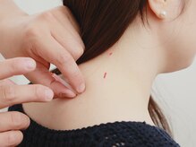 星の鍼灸接骨院/【首・肩こり】