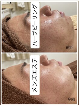 エムケーサロン(MK salon)/白ニキビが…減りました