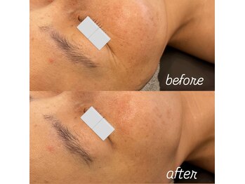 リノ(Lino)/プラズマbefore after