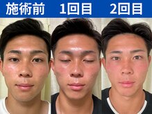 ナチュラルビューティーフェイス 横浜(NBF)/MENS小顔矯正/ビフォーアフター