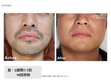 サロン アンネ(Anne)/高松市メンズ脱毛