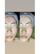 マリー(Mary.)/乾燥による赤み