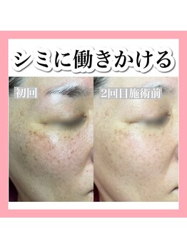 エミュローズ 段原店(Nm' Rose)/１回でシミが減って驚いた
