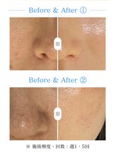 ホジュン鍼灸整体院/セラピール5回肌改善