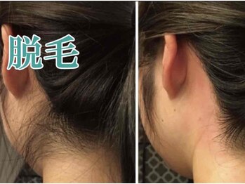 美宝 元町の写真/３２年愛され続ける実力派の０美肌脱毛◎脱毛しながらうるツヤ美肌へ★最短４カ月で卒業です♪８歳からOK◎