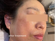 オアシスラグーン(OASIS LAGOON)/シミケア（症例４：after）