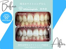 ホワイトニングカフェ 志木店/ホワイトニングbefore after