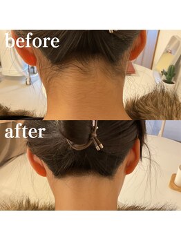 ミノア 大野城店(MINOA)/うなじ脱毛◆ビフォーアフター