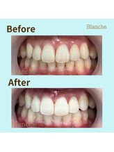 ホワイトニングサロン Blanche 心斎橋店/ビフォーアフター
