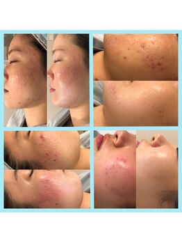 ビューティースタジオ韓美 池袋店の写真/毛穴づまり・ザラつきを徹底ケア。毛穴洗浄で汚れをすっきり落とし、仕上げに毛穴をキュッと引き締めます。