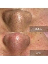 クラルテ(Clarte)/毛穴エクストラクション