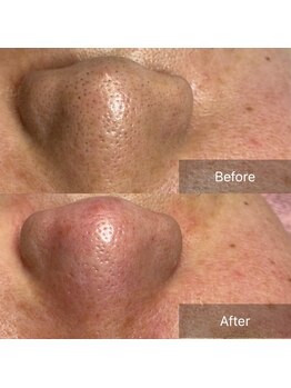 クラルテ(Clarte)/毛穴エクストラクション