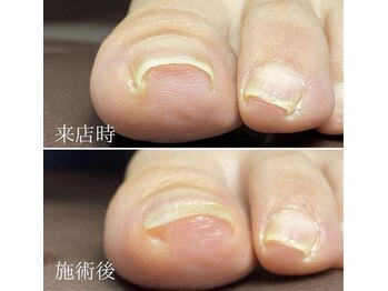 プレシオサ ネイル(Preciosa Nail)/巻き爪補正