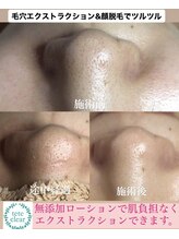 ビューティーネイル(Beauty Nail)/毛穴エクストラクション