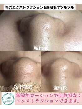 ビューティーネイル(Beauty Nail)/毛穴エクストラクション