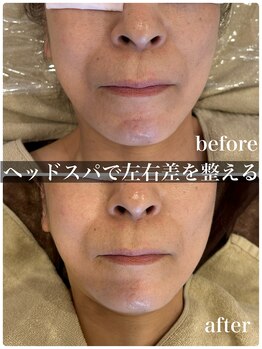 マルコ(marco)/ヘッドスパでリフトアップと小顔
