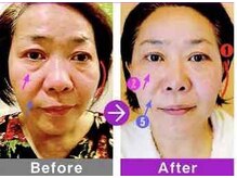 ラヴィアンローズ(LavieenRose)/πセラピー小顔矯正術の効果