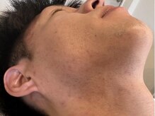 オアシスラグーン(OASIS LAGOON)/メンズ脱毛（症例４：after）