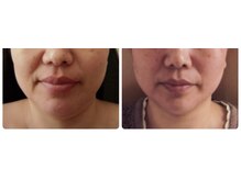 小顔矯正アンドフェイシャルサロン アンベリール(embellir)/小顔矯正ビフォーアフター４