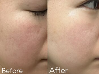 カレンジェビューティー(CarengeBeauty)/プラチナクレイピール