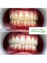 ホワイトニングサロン 名古屋駅店/【ホワイトニング施術例】