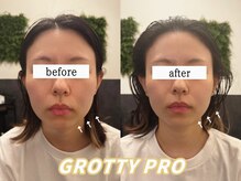 最新美容マシンでリフトUP、たるみ改善でフェイスラインすっきり