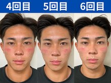 ナチュラルビューティーフェイス 横浜(NBF)/MENS小顔矯正/ビフォーアフター