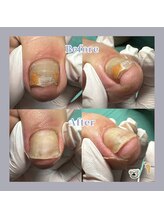 巻き爪補正店 天王寺店/ネイルで隠さず、早めのケアを！