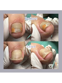 巻き爪補正店 天王寺店/ネイルで隠さず、早めのケアを!