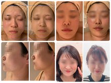 小顔コルギ×独自メソッドの顎調整で小顔へ！美肌も同時進行で◎