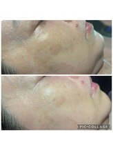 ハルハル(Haru Haru)/お肌のリボーニング