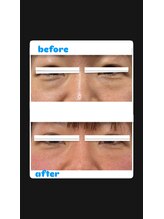 ナナラ(NANALA)/REDSHOT 目元集中ケア