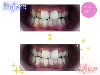 エクシアホワイトニング 天王寺店/ホワイトニングビフォーアフター