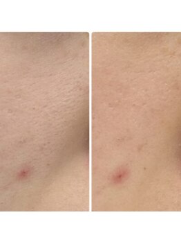 プレイス 堂山本店(PLACE)/ハーブピーリング