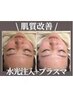 小顔×肌質改善★ノンニードル水光注入+ダーマプラズマエクソソーム￥7700