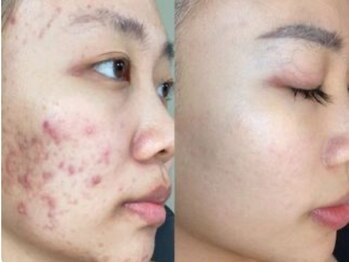 マリヴェリーテ(Mari verite)の写真/【ニキビ/赤みに本気でお悩みの方へ】ピーリング角質オフ×希少な温熱はちみつを30層に重ね潤い浸透&保湿◎
