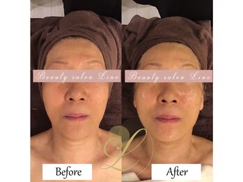 リノ(Lino)/70代の方ぼビフォーアフター♪