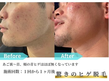 プラスワン/ヒゲ脱毛の効果