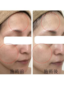 エヌミー(N me)/水素＋毛穴ブラシコース　