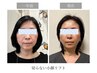 全身施術　切らない小顔リフト￥38,500⇒