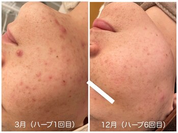 メゾンリュバン 梅田店(Maison Ruban)/ハーブピーリング・水光ジェット