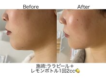 マスカレード 品川(Masquerade)/【症例写真】小顔レモンボトル