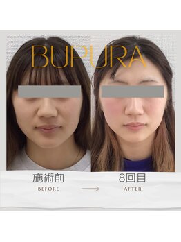 ブプラ 光の森店(BUPURA)/お客様ビフォーアフター