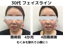 エンジェルエッグ/◆フェイスラインが整う！